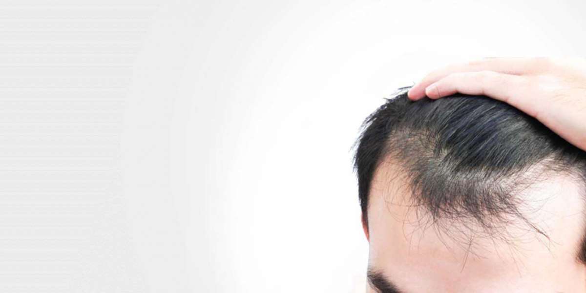 FUE Hair Transplant- A Smart Approach For Managing Baldness